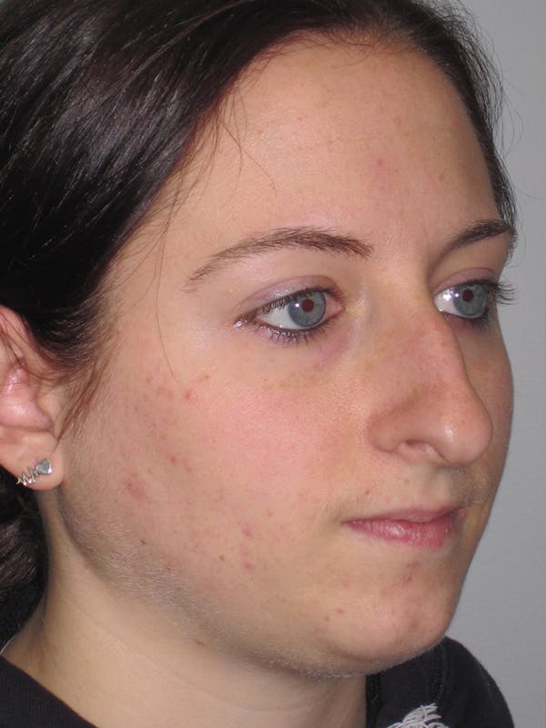 Rhinoplasty Before & After Gallery - Patient 11110016 - Image 3