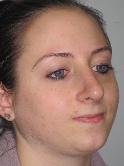 Rhinoplasty Before & After Gallery - Patient 11110016 - Image 4