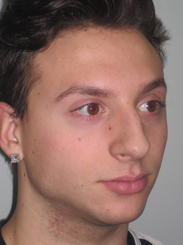 Rhinoplasty Before & After Gallery - Patient 11110017 - Image 5