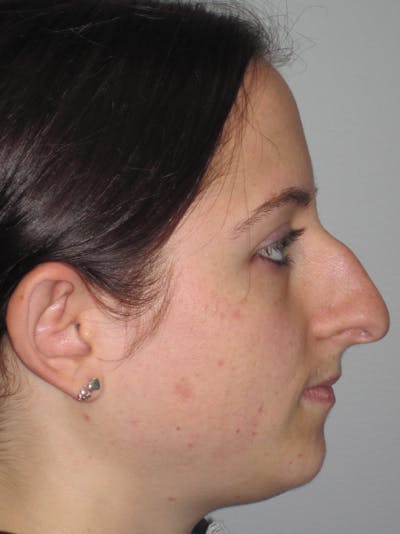 Rhinoplasty Before & After Gallery - Patient 11110016 - Image 1