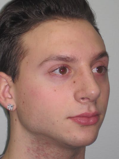 Rhinoplasty Before & After Gallery - Patient 11110017 - Image 6
