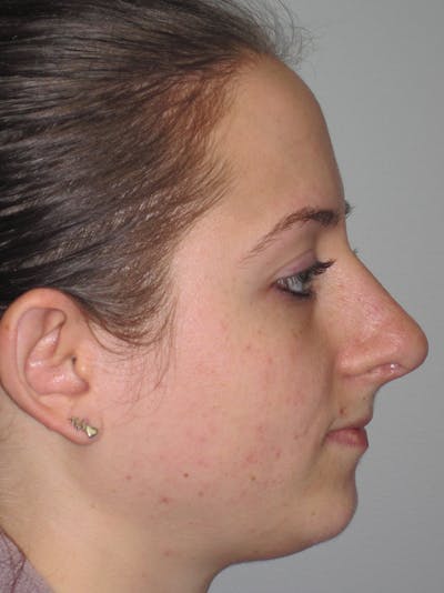 Rhinoplasty Before & After Gallery - Patient 11110016 - Image 2