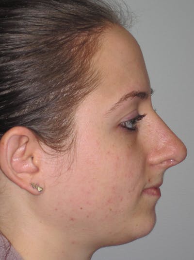 Rhinoplasty Before & After Gallery - Patient 11110016 - Image 2