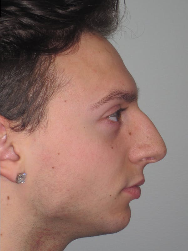 Rhinoplasty Before & After Gallery - Patient 11110017 - Image 3