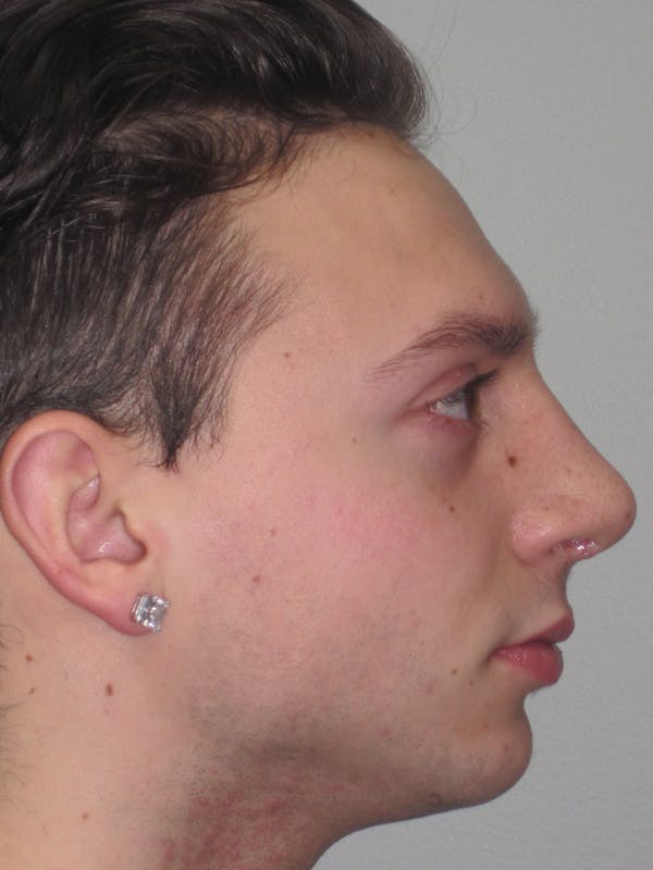 Rhinoplasty Before & After Gallery - Patient 11110017 - Image 4