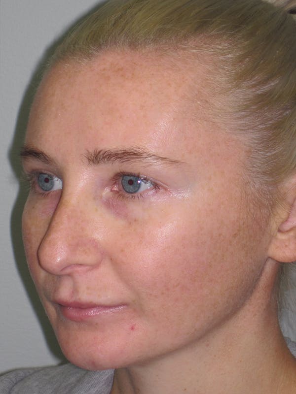 Rhinoplasty Before & After Gallery - Patient 11110018 - Image 3