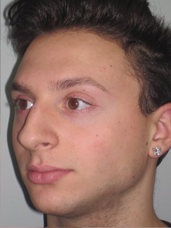 Rhinoplasty Before & After Gallery - Patient 11110017 - Image 7