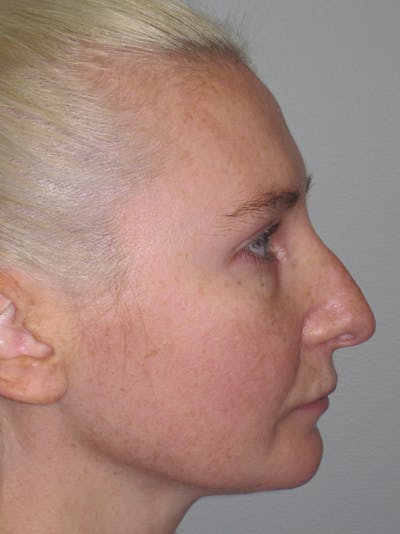 Rhinoplasty Before & After Gallery - Patient 11110018 - Image 1
