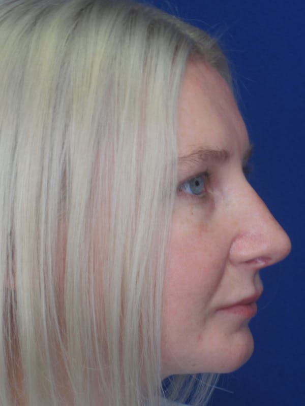 Rhinoplasty Before & After Gallery - Patient 11110018 - Image 2