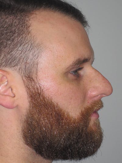 Rhinoplasty Before & After Gallery - Patient 11110019 - Image 1