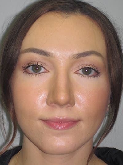 Rhinoplasty Before & After Gallery - Patient 11110020 - Image 8