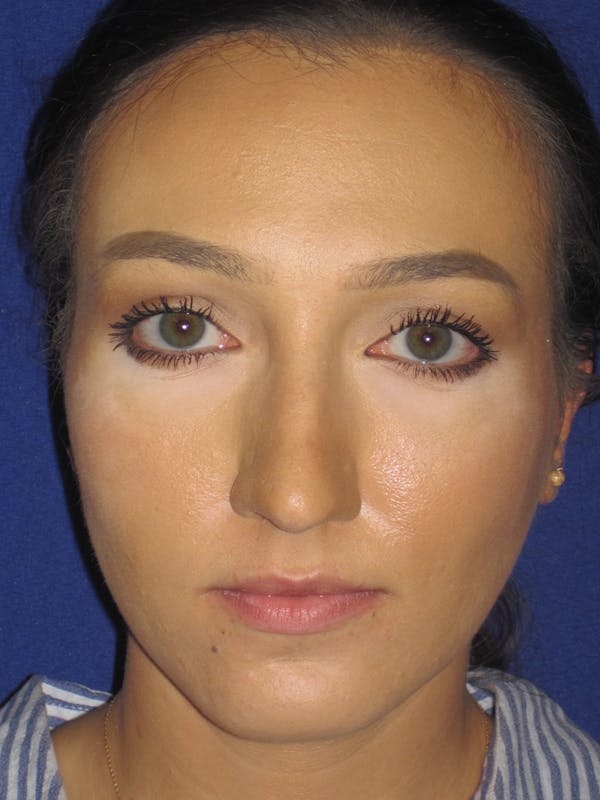 Rhinoplasty Before & After Gallery - Patient 11110020 - Image 7