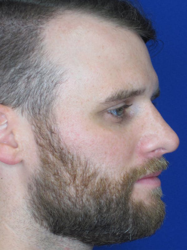 Rhinoplasty Before & After Gallery - Patient 11110019 - Image 2