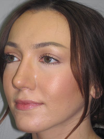 Rhinoplasty Before & After Gallery - Patient 11110020 - Image 4