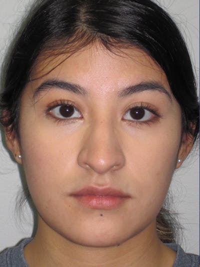 Rhinoplasty Before & After Gallery - Patient 11110021 - Image 1