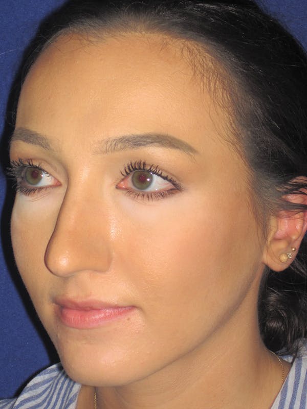 Rhinoplasty Before & After Gallery - Patient 11110020 - Image 3