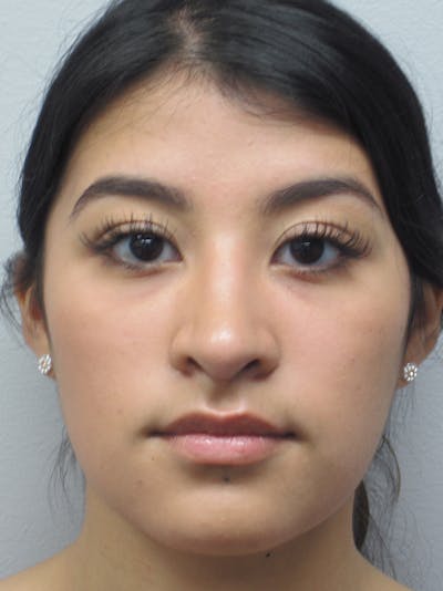 Rhinoplasty Before & After Gallery - Patient 11110021 - Image 2