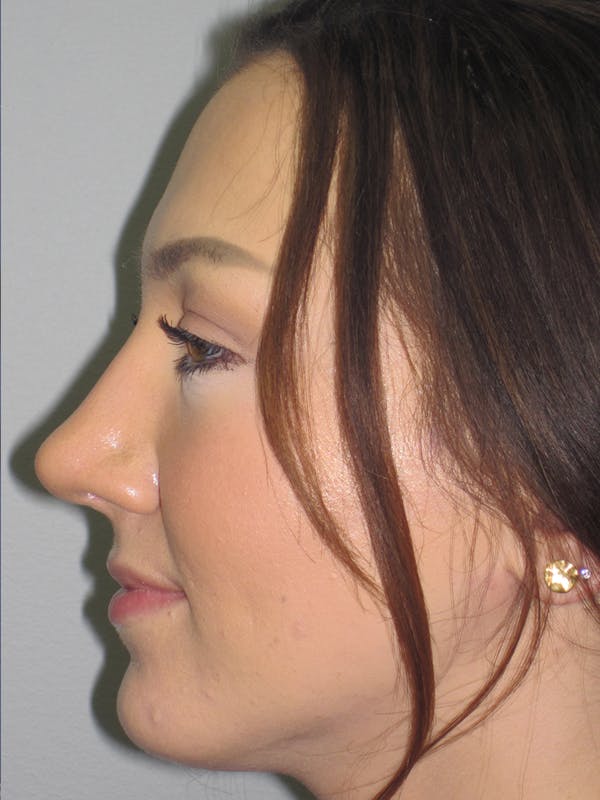 Rhinoplasty Before & After Gallery - Patient 11110020 - Image 6