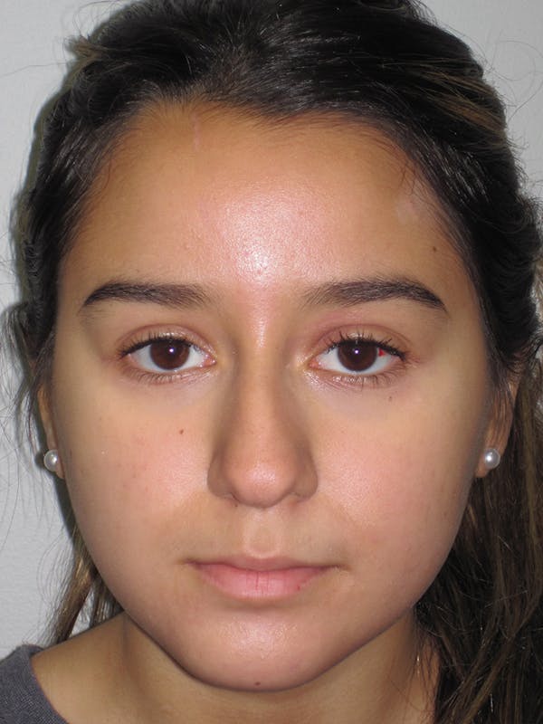 Rhinoplasty Before & After Gallery - Patient 11110022 - Image 7