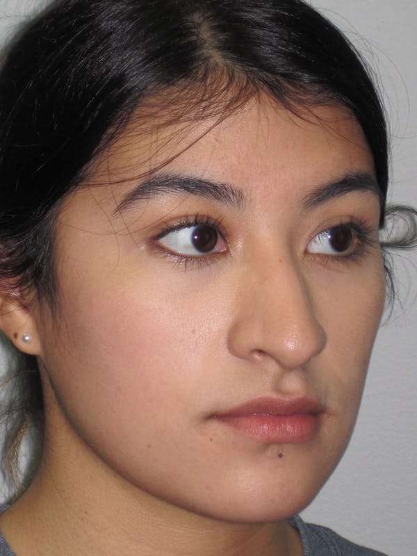 Rhinoplasty Before & After Gallery - Patient 11110021 - Image 3