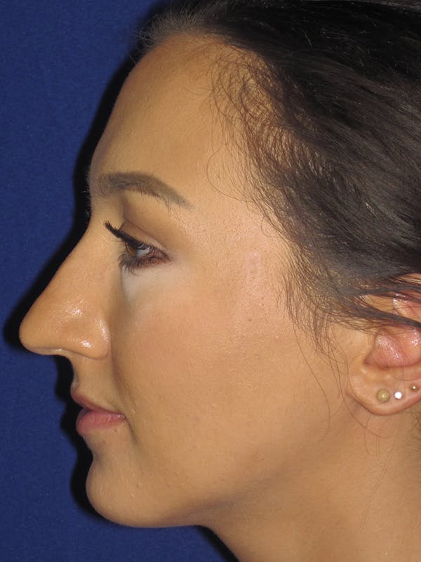Rhinoplasty Before & After Gallery - Patient 11110020 - Image 5