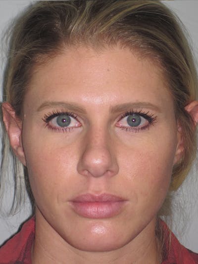 Rhinoplasty Before & After Gallery - Patient 11110023 - Image 1