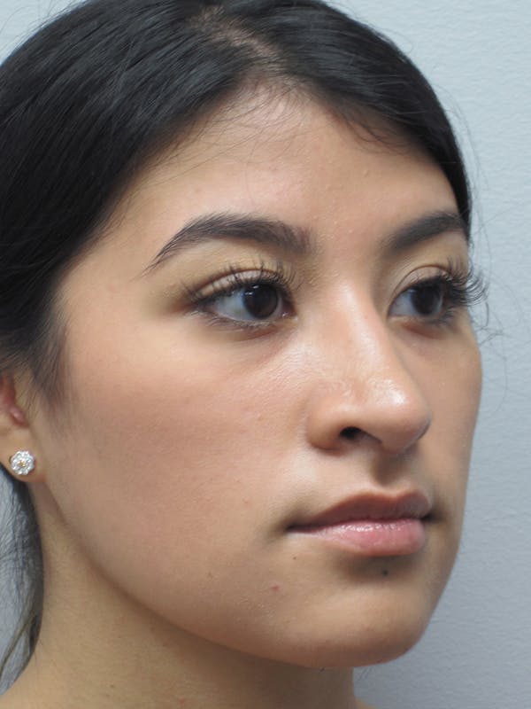 Rhinoplasty Before & After Gallery - Patient 11110021 - Image 4