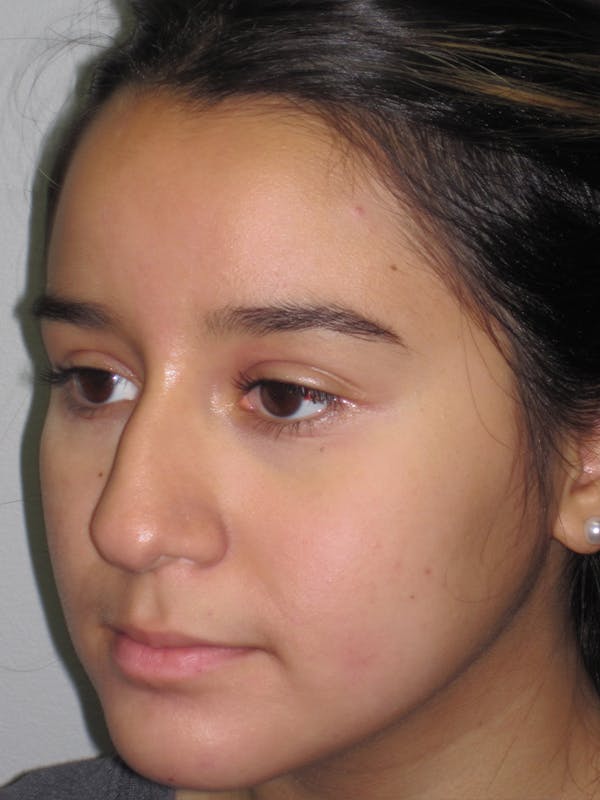 Rhinoplasty Before & After Gallery - Patient 11110022 - Image 3