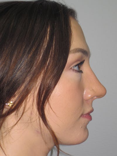 Rhinoplasty Before & After Gallery - Patient 11110020 - Image 2