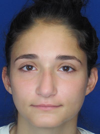 Rhinoplasty Before & After Gallery - Patient 11110024 - Image 1