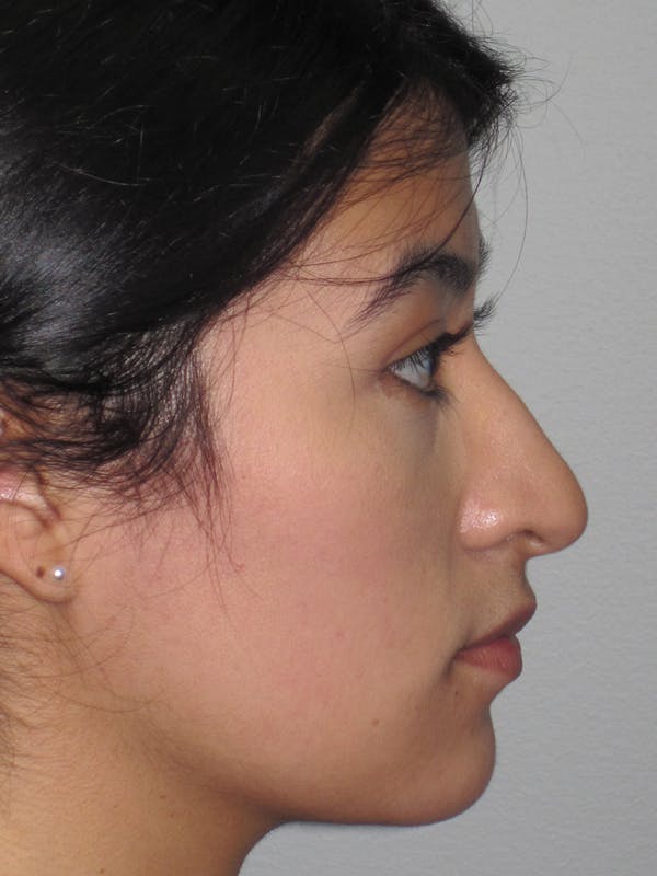 Rhinoplasty Before & After Gallery - Patient 11110021 - Image 7