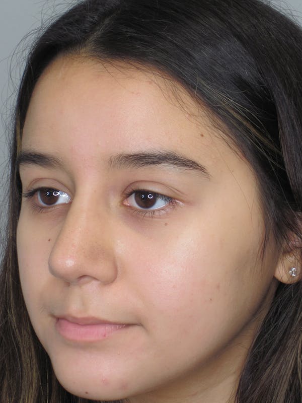 Rhinoplasty Before & After Gallery - Patient 11110022 - Image 4