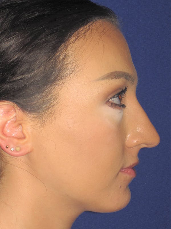 Rhinoplasty Before & After Gallery - Patient 11110020 - Image 1