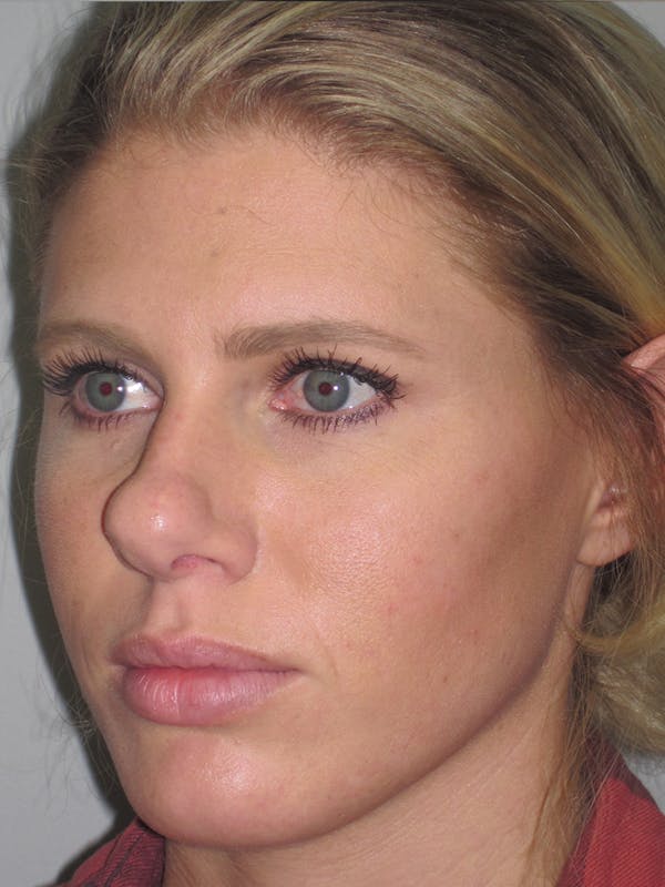Rhinoplasty Before & After Gallery - Patient 11110023 - Image 5