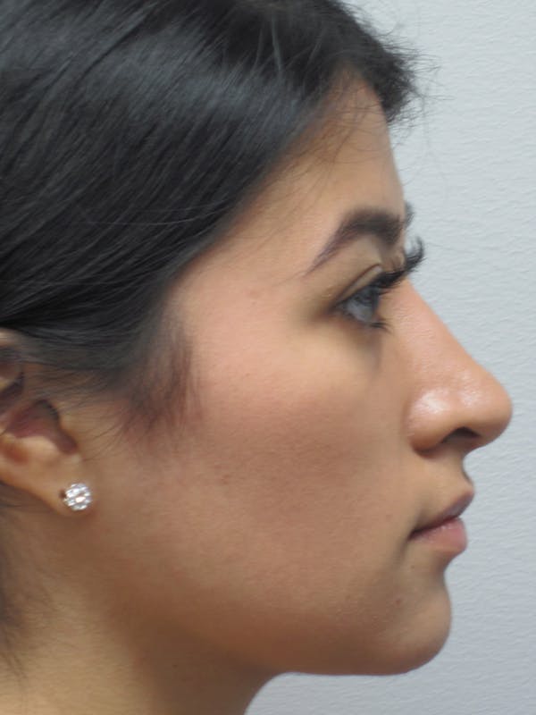 Rhinoplasty Before & After Gallery - Patient 11110021 - Image 8
