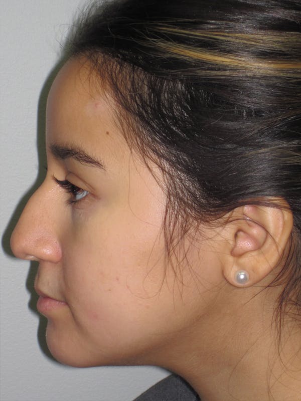 Rhinoplasty Before & After Gallery - Patient 11110022 - Image 5