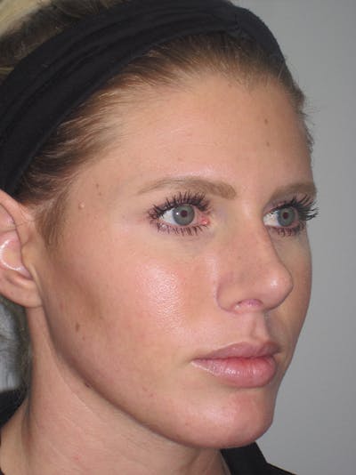 Rhinoplasty Before & After Gallery - Patient 11110023 - Image 4