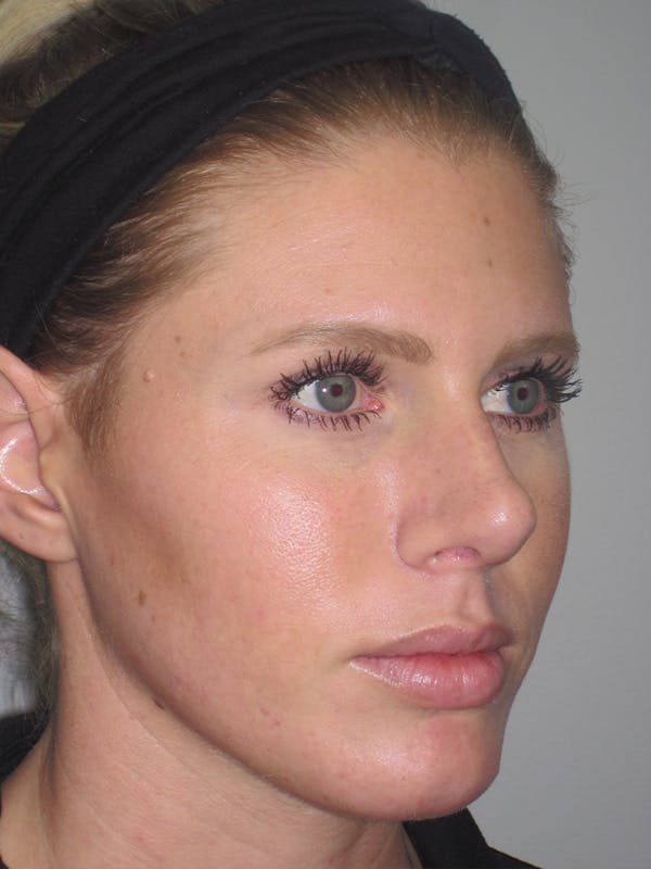 Rhinoplasty Before & After Gallery - Patient 11110023 - Image 4