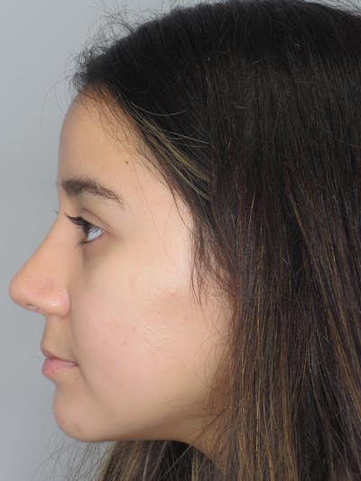 Rhinoplasty Before & After Gallery - Patient 11110022 - Image 6