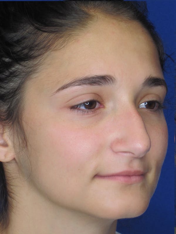 Rhinoplasty Before & After Gallery - Patient 11110024 - Image 3