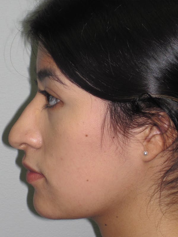 Rhinoplasty Before & After Gallery - Patient 11110021 - Image 5