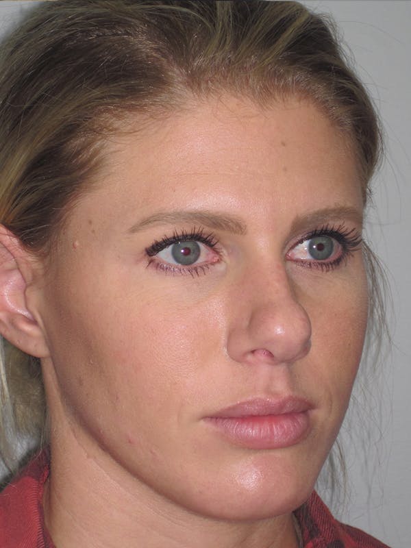 Rhinoplasty Before & After Gallery - Patient 11110023 - Image 3