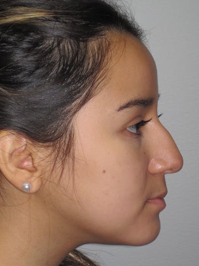 Rhinoplasty Before & After Gallery - Patient 11110022 - Image 1