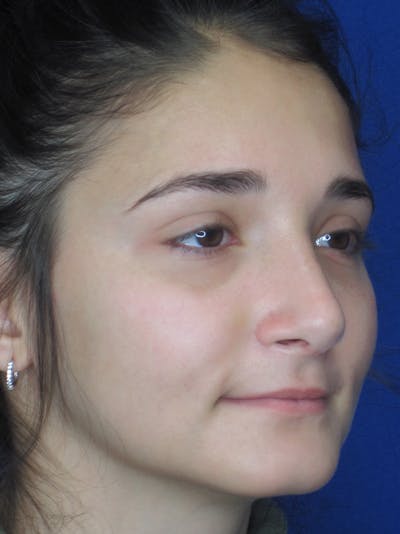 Rhinoplasty Before & After Gallery - Patient 11110024 - Image 4