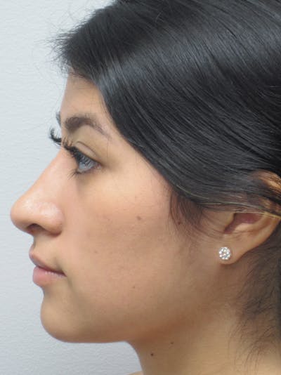 Rhinoplasty Before & After Gallery - Patient 11110021 - Image 6