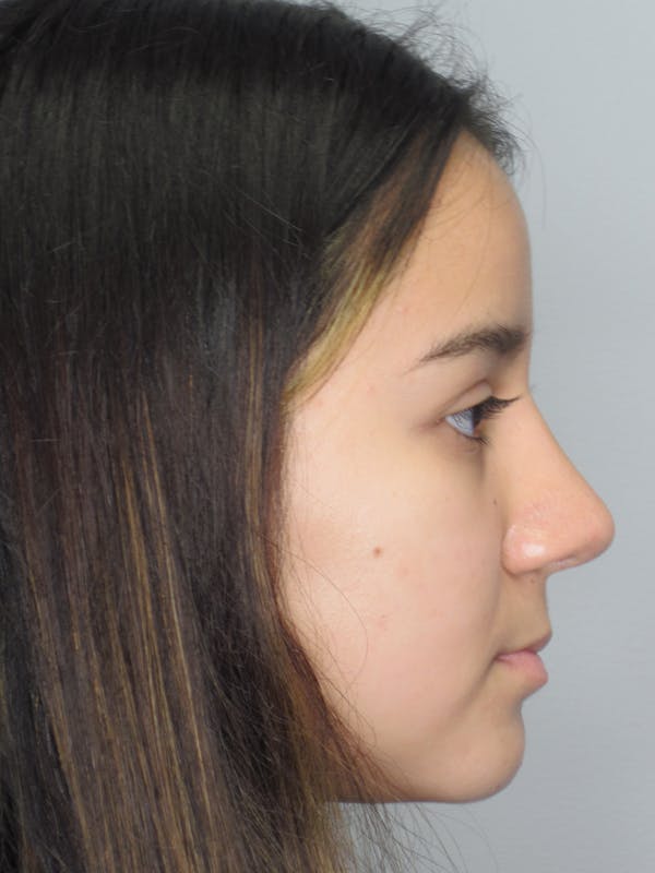 Rhinoplasty Before & After Gallery - Patient 11110022 - Image 2
