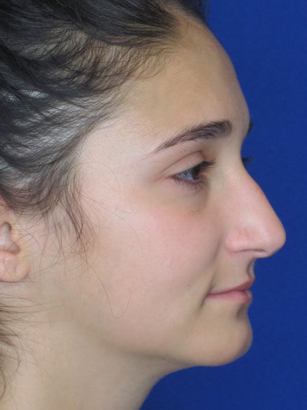 Rhinoplasty Before & After Gallery - Patient 11110024 - Image 5