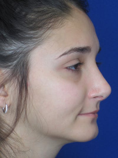 Rhinoplasty Before & After Gallery - Patient 11110024 - Image 6