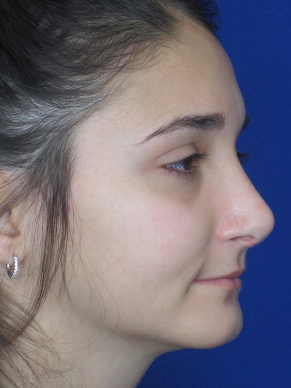 Rhinoplasty Before & After Gallery - Patient 11110024 - Image 6