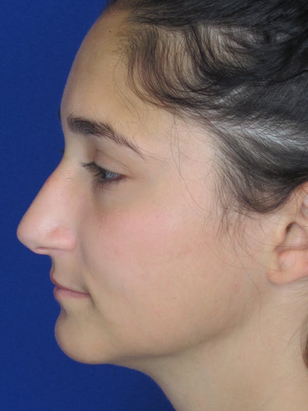 Rhinoplasty Before & After Gallery - Patient 11110024 - Image 7